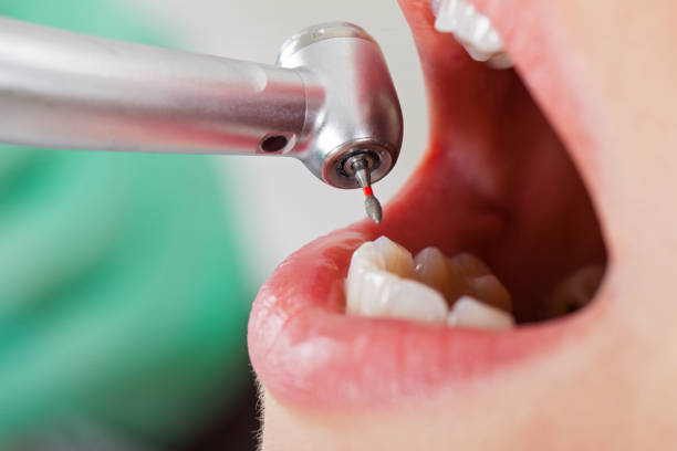 Best Emergency Dental Care for Broken or Chipped Teeth in Jamestown, TN